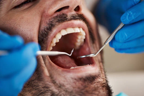 Best Emergency Dental Extractions in Roscoe, TX